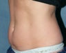 Stomach Liposculpture