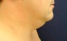 Male Neck Lipo 