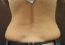 Lipo for Back and Love Handles