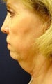 Neck liposculpture