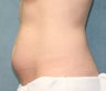 Stomach lipo
