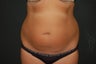 true tumescent liposuction 