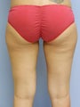 Liposculpture