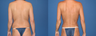 Liposuction