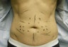 High-Definition Liposuction