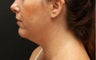 Laser-Assisted Lipocontouring of the Neck