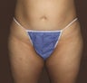 Liposuction of Abdomen, Inner Thighs and Outer Thighs