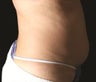 LipoSculpting of Upper and Lower Abdomen and Love Handles