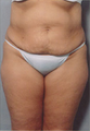 Tummy Tuck