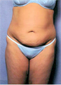 Tummy Tuck