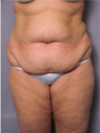 Adominoplasty