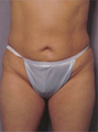 Abdominoplasty
