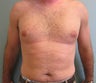 Liposculpture