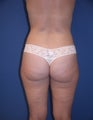 Before & After Liposculpture of the buttocks, thighs & hips