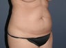 Liposculpture