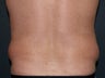 Body Liposculture