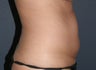 Liposculpture