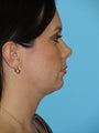 Neck Liposuction