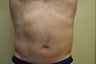 Liposuction of the abdomen and flanks (side/lower back)