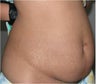 Liposculpture