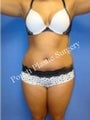 Liposuction