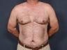 Liposuction