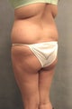 Liposuction