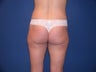 Liposculpture of Thighs, Hips and Buttocks