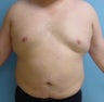 Male liposuction/liposculpture