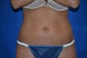 Liposonix