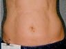 Liposonix