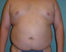 Male liposuction/liposculpture