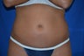 Liposonix
