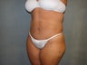 Tummy Tuck