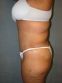 Tummy Tuck and Liposuction