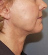 Liposuction