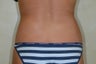 Liposuction of Hip Rolls