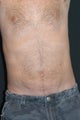 Liposuction