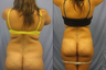 Liposuction