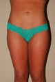 Liposuction