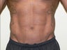Liposuction