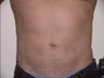 Liposuction