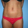 Liposuction