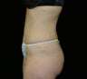 abdominoplasty with lipo