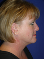 Liposuction of neck