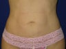 Liposuction