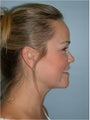 Neck Liposuction (submental liposuction)