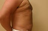 Liposuction