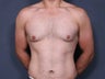 Liposuction