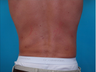 Liposuction